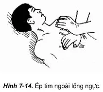 Phương pháp thổi ngạt và ép tim ngoài lồng ngực Phuong Phap Thoi Ngat Va Ep Tim Ngoai Long Nguc 1