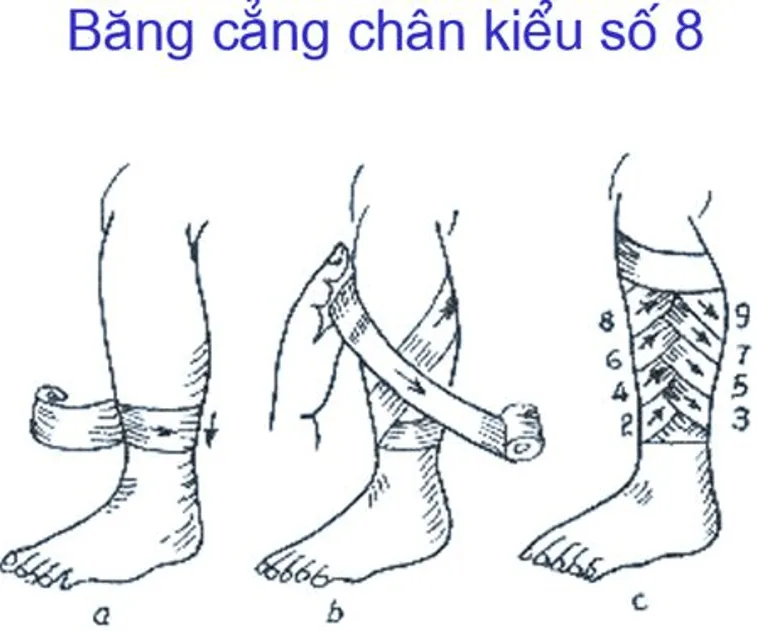Lý thuyết GDQP 10 Cánh diều Bài 2: Kĩ thuật cấp cứu và chuyển thương (ảnh 7) Ly Thuyet Bai 2 Ki Thuat Cap Cuu Va Chuyen Thuong 157382