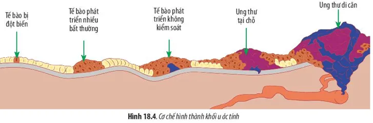 Hãy quan sát Hình 18.4 và cho biết cơ chế hình thành khối u ác tính Cau Hoi 8 Trang 87 Sinh Hoc 10